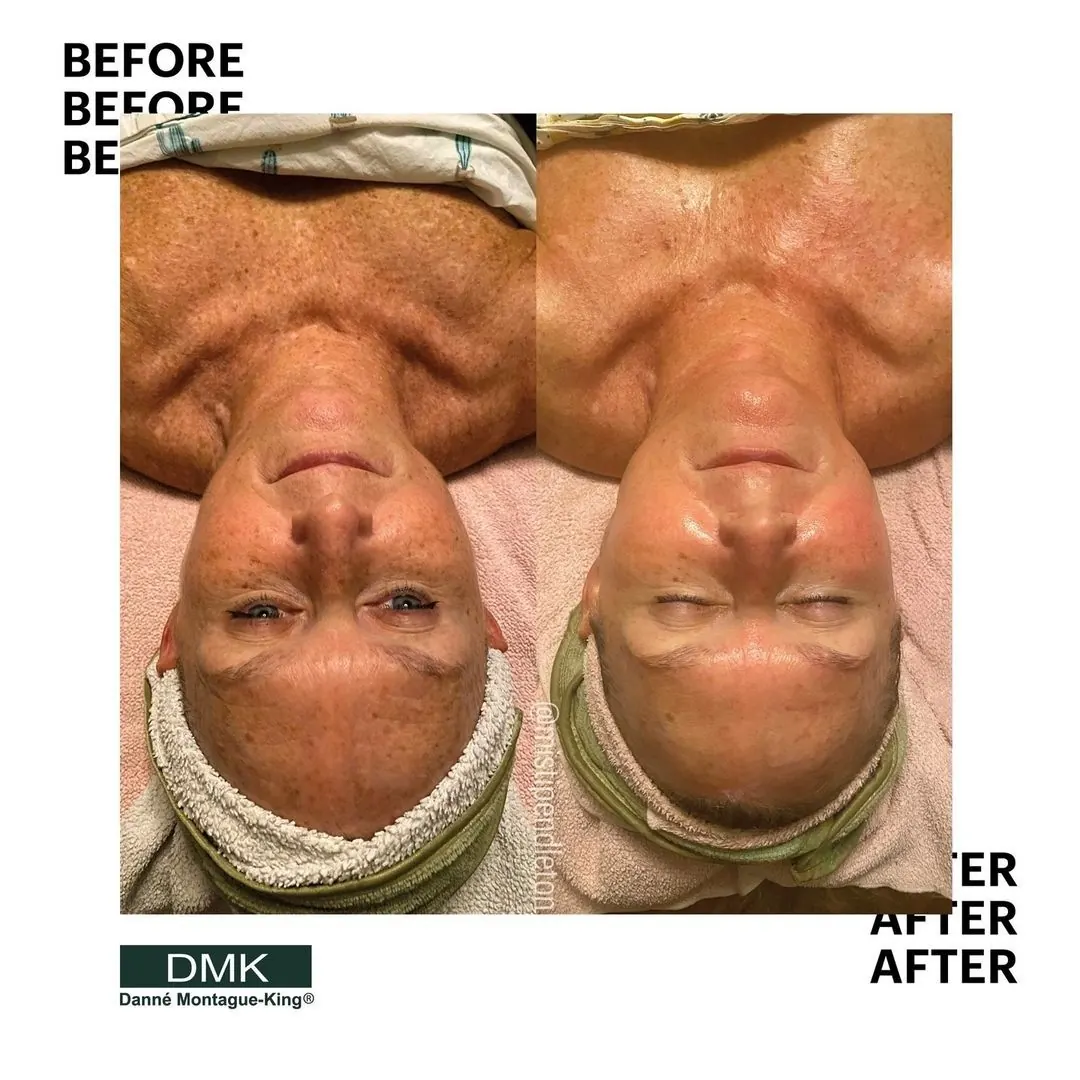 IYU facial treatment result
